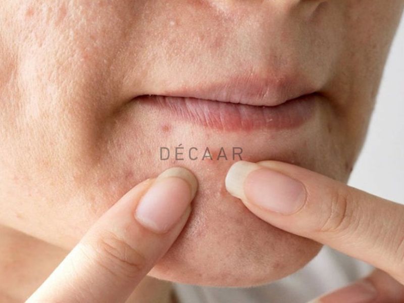  Tránh tự ý nặn mụn